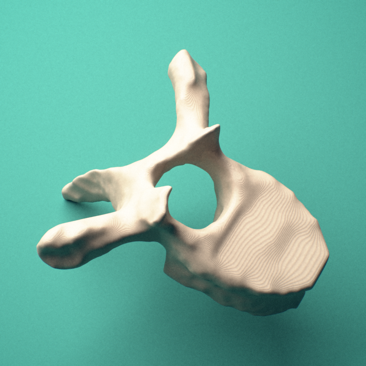 3D-printed T5 thoracic vertebra, posterior oblique view showing the laminae and spinous process.
