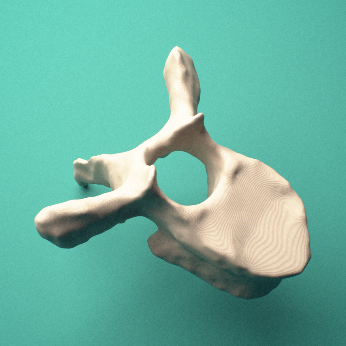 3D-printed T6 thoracic vertebra, posterior oblique view showing the laminae and spinous process.