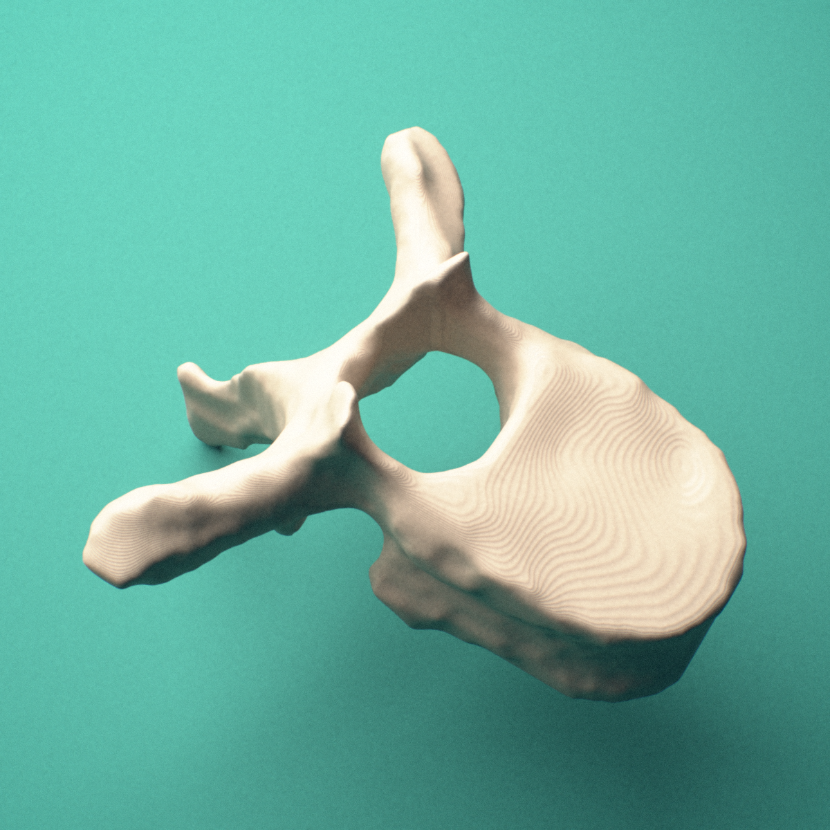 3D-printed T7 thoracic vertebra, posterior oblique view showing the laminae and spinous process.