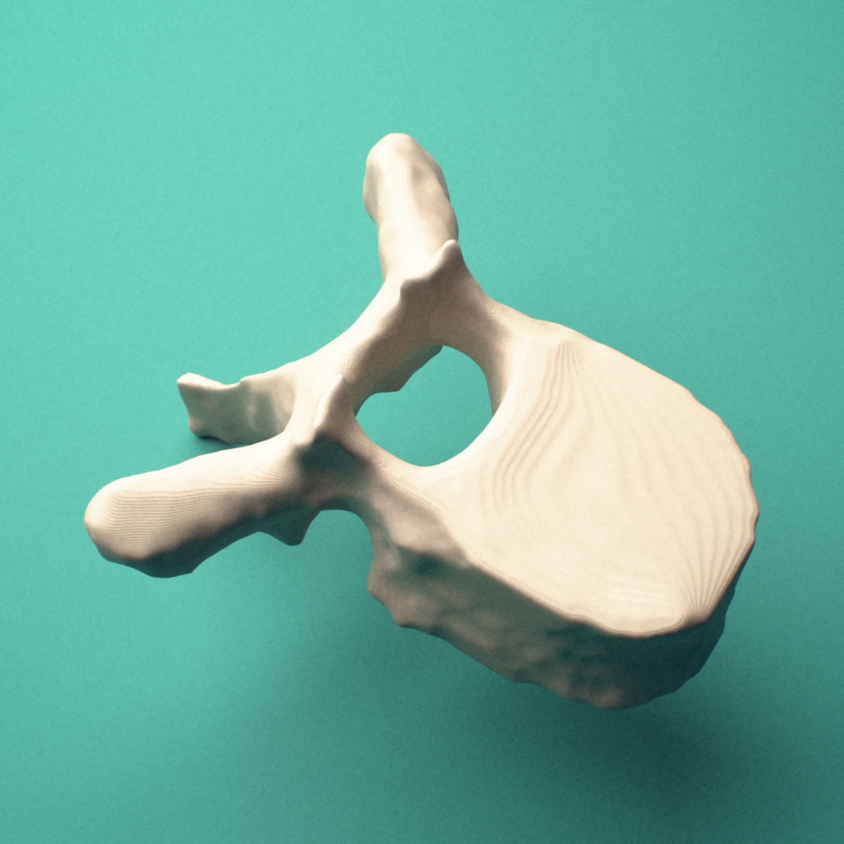 3D-printed T8 thoracic vertebra, posterior oblique view showing the laminae and spinous process.