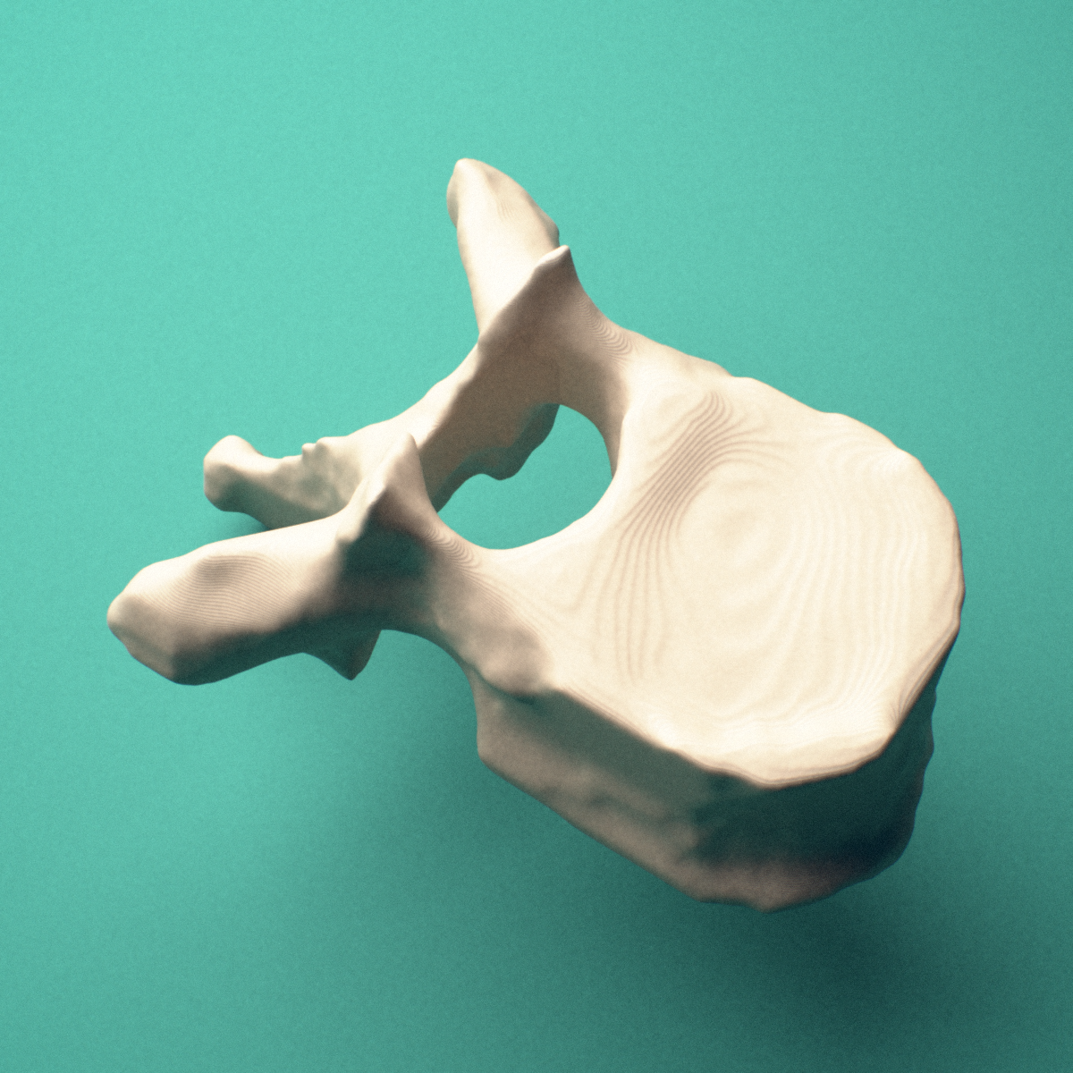 3D-printed T9 thoracic vertebra, posterior oblique view showing the laminae and spinous process.