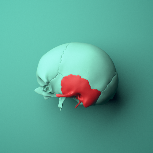 3D model of the Left temporal bone shown in position within a full skull model, left lateral view.