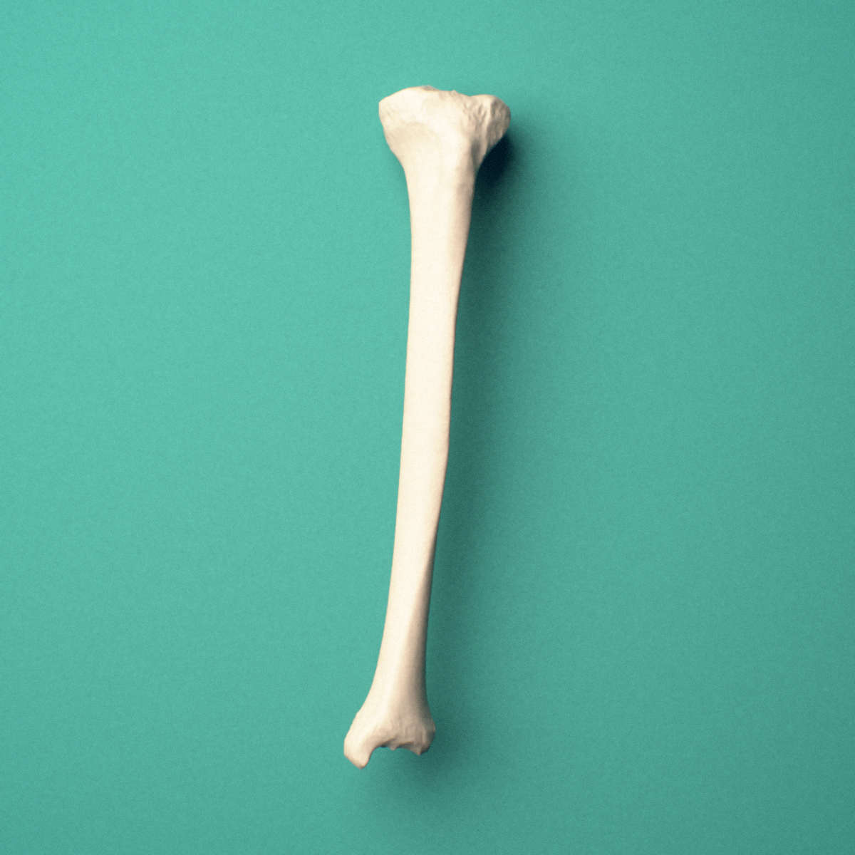 3D-printed Left tibia (shinbone), oblique close-up view showing the medial and lateral condyles from this angle.